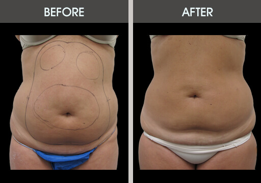 Liposuction Before And After Front View
