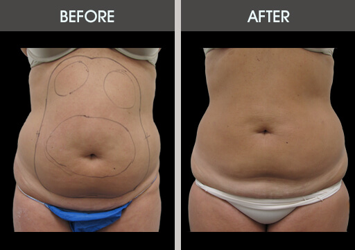 Liposuction Before and After