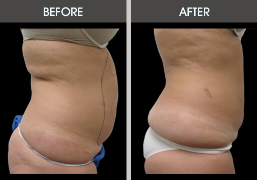 Liposuction Before And After Right Side View