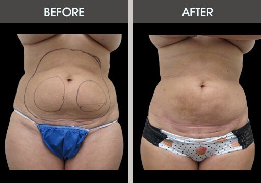 Lipo Before And After Front View