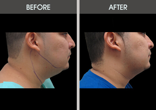 Chin Liposuction Before And After