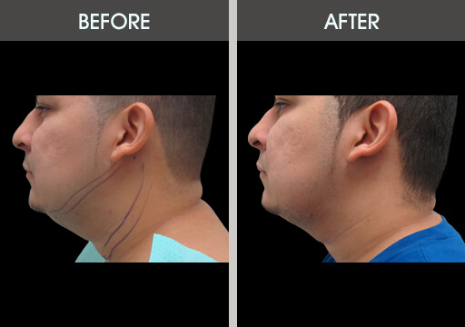 Chin Lipo Before And After