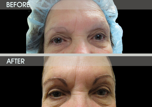 Browlift Surgery Before And After