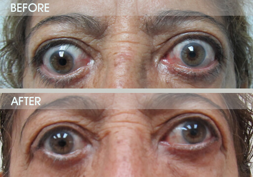 Ectropion Treatment Before And After