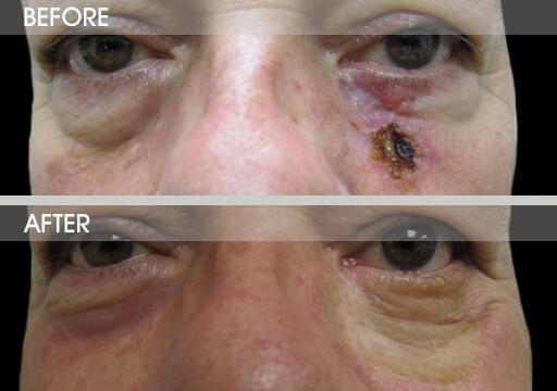 Eyelid Tumor Procedure Before And After