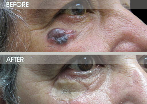 Eyelid Tumor Removal Surgery Before And After