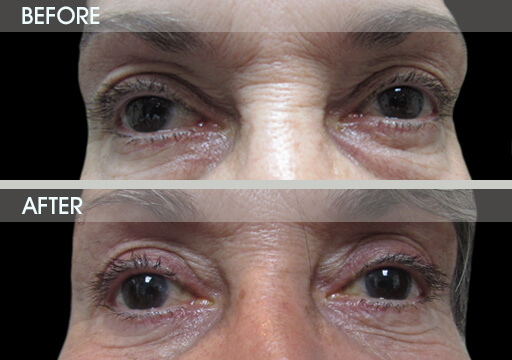 Eyelid Surgery Results