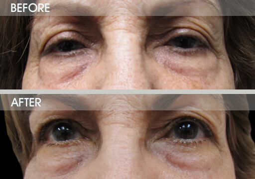 Ptosis Treatment Before And After