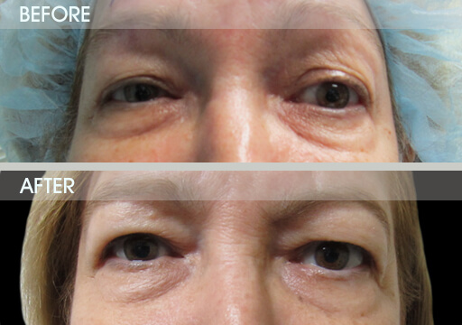 Ptosis Eyelid Surgery Before And After