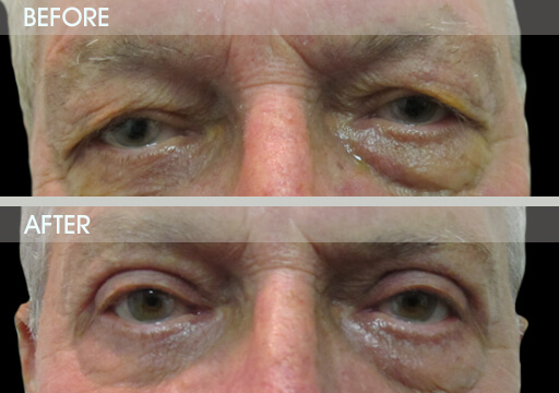 Blepharoplasty Procedure Before And After