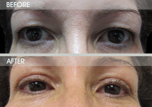 Eyelid Restoration Before And After