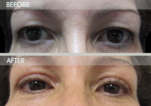 Eyelid Restoration Before And After