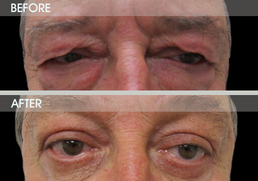 Upper Eyelid Restoration Before And After