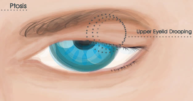 Drooping Eyelid Treatment